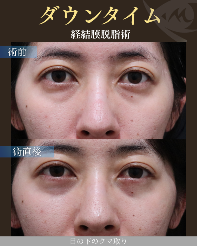 40代女性 経結膜脱脂術 ダウンタイム
